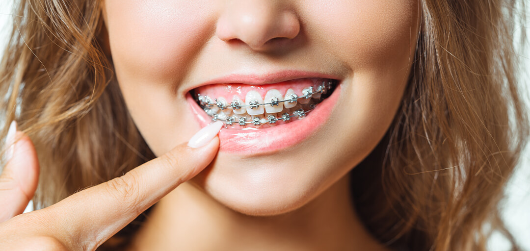 Will braces fix an overbite? Your Gold Coast guide