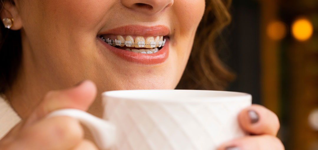 How Long Do LightForce™ Braces Take? Timelines and Tips
