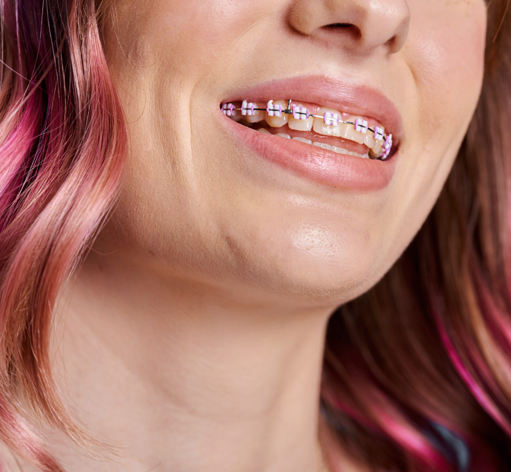 What are LightForce™ 3D Braces? What are LightForce™ 3D Braces?
