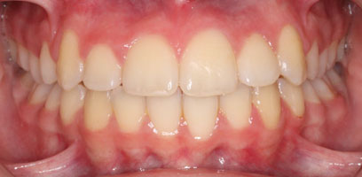 Before & Afters