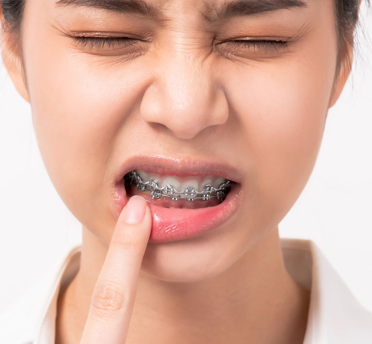 Discomfort after
a braces adjustment Discomfort after
a braces adjustment