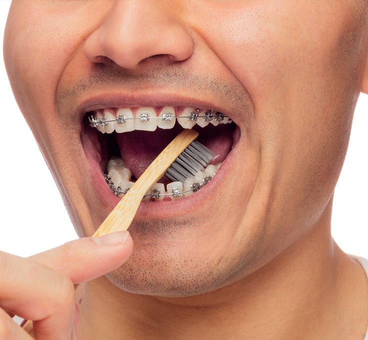 Food caught
in braces Food caught
in braces