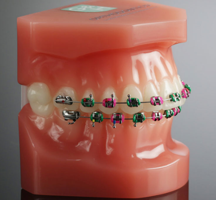 Loose or
broken brackets