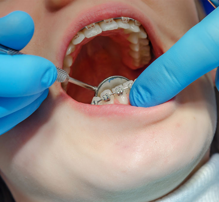 Mouth ulcers
or sore spots Mouth ulcers
or sore spots