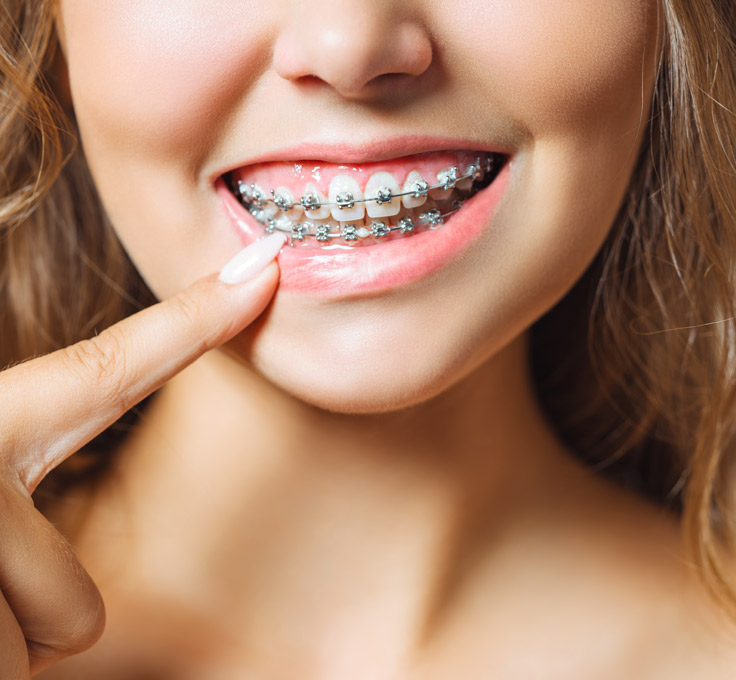 What are metal braces? What are metal braces?